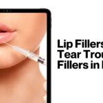 Lip Fillers and Tear Trough Fillers in Delhi